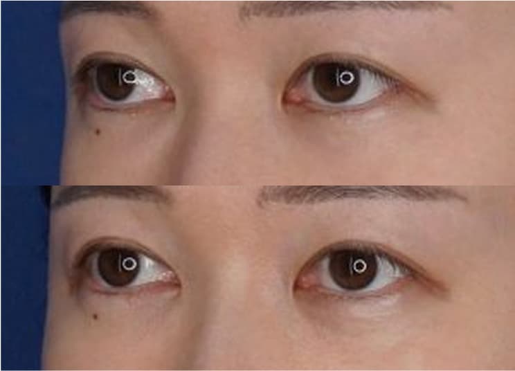 下まぶたのたるみとり