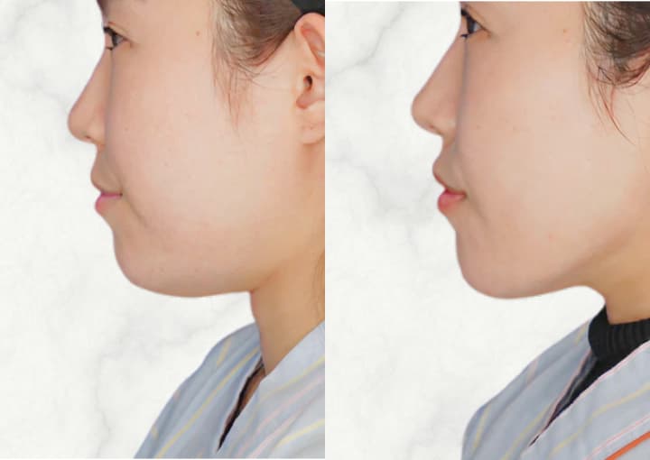 脂肪吸引+糸リフト