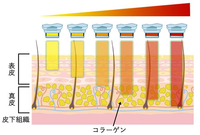 フォトフェイシャルの特徴