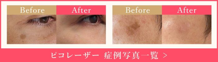 ピコレーザー症例写真一覧