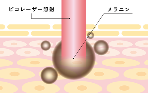 ピコレーザーを照射