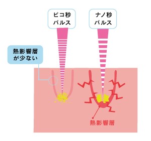 周りの組織を傷つけず シミだけを効能的に治療できる