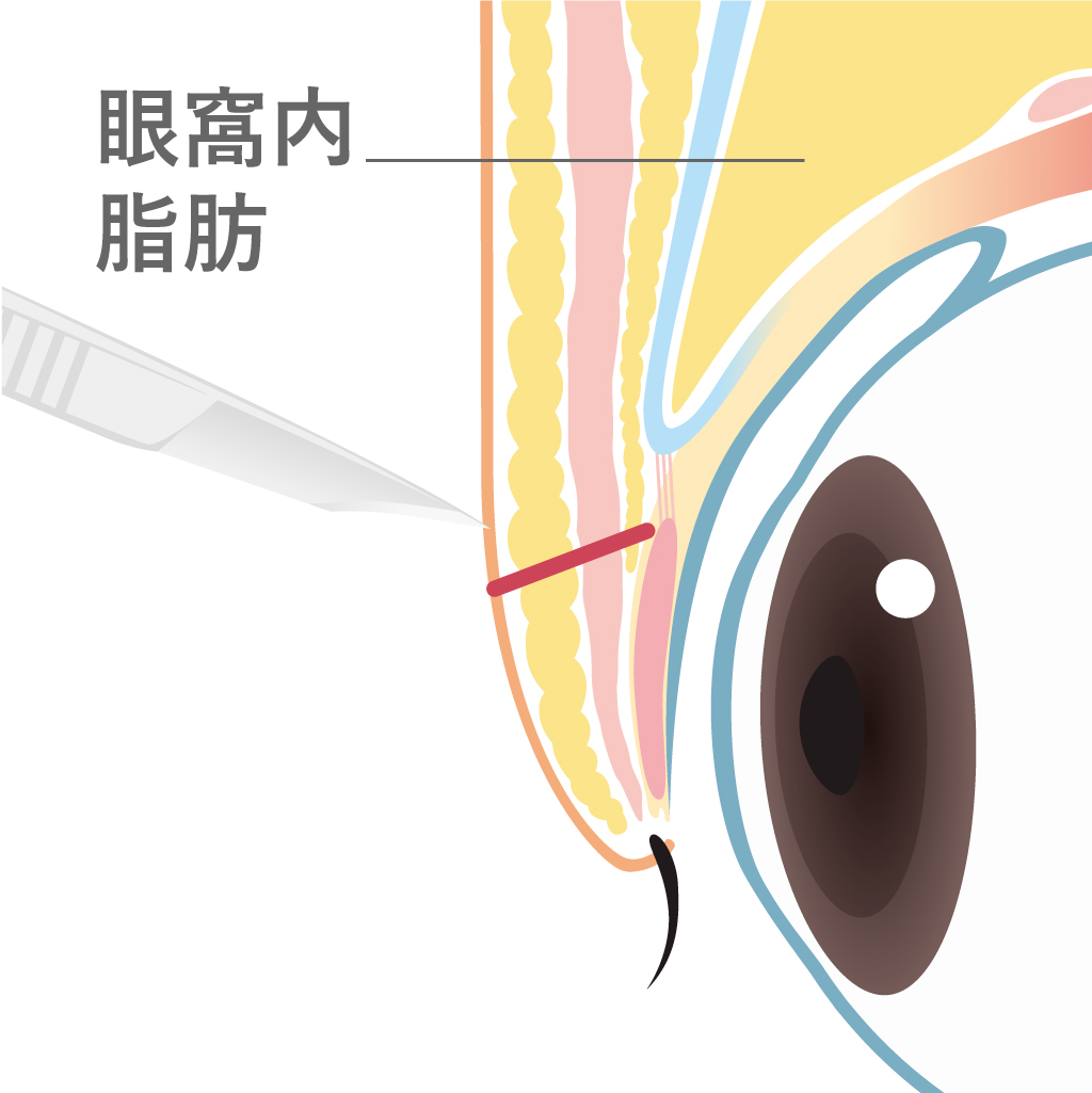 二重切開デザイン