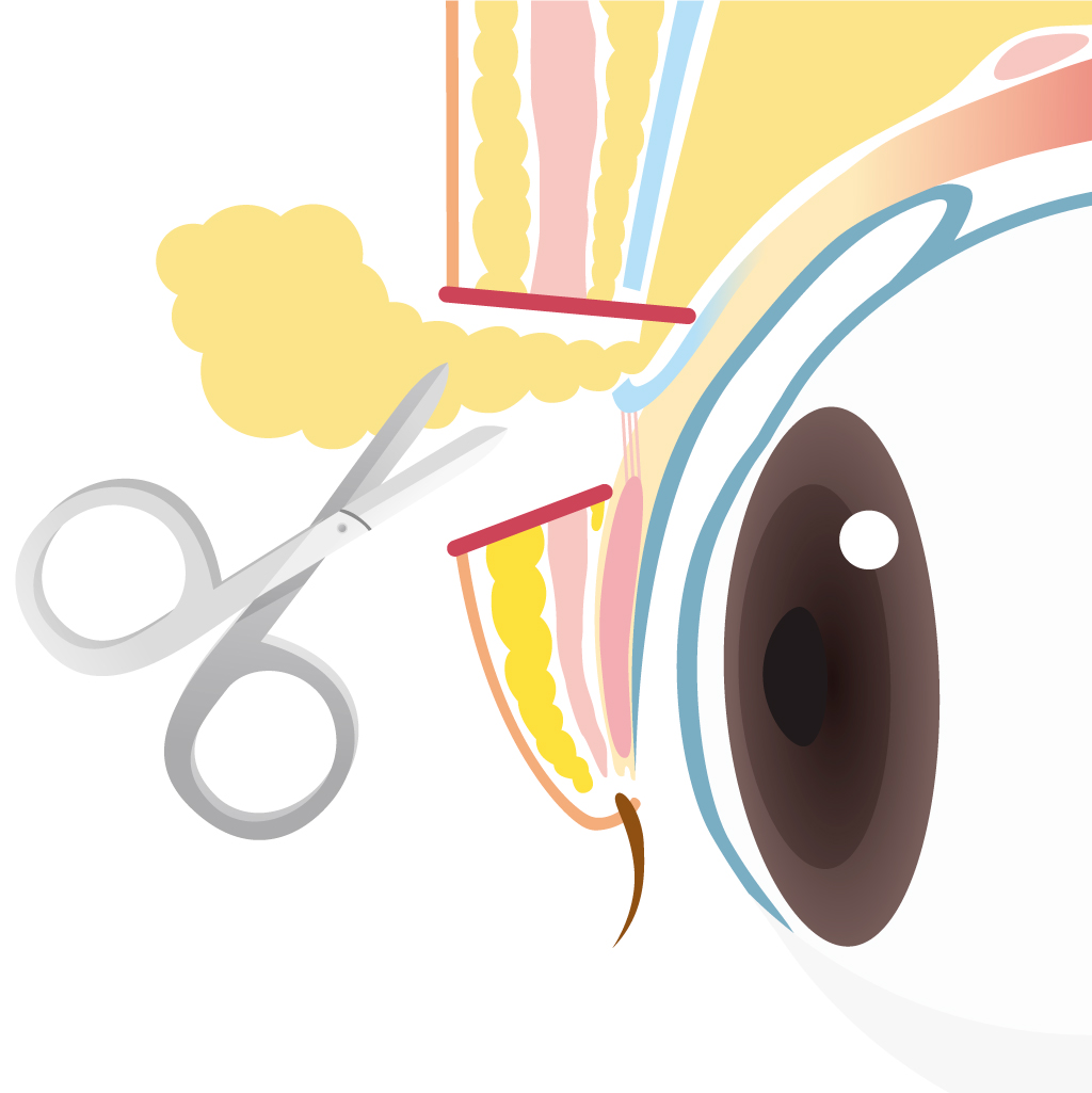 二重切開デザイン