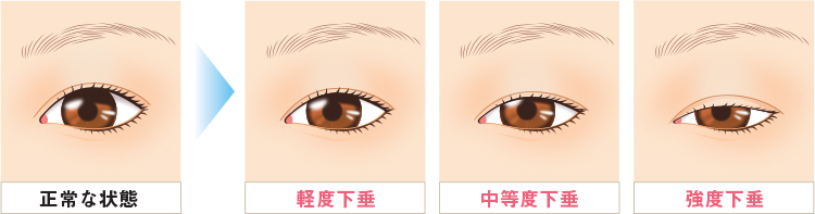 眼瞼下垂について