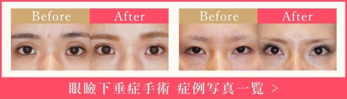 眼瞼下垂症手術(上まぶたのたるみ取り)の症例写真