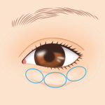 目の下の脂肪取り1