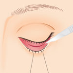 目の下の脂肪取り2