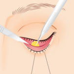 目の下の脂肪取り3