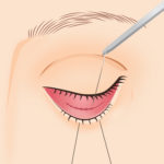 目の下の脂肪取り4