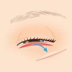 逆さまつ毛修正2