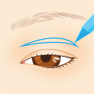 眼瞼下垂症手術01