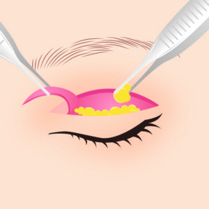 眼瞼下垂症手術02