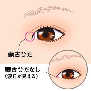 目頭切開とは