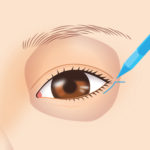 目尻靭帯移動術