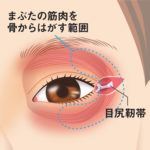 目尻靭帯移動術2
