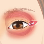 目尻靭帯移動術3