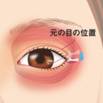 目尻靭帯移動術4