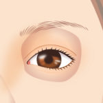 目尻靭帯移動術5