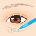 下まぶたのくぼみ修正