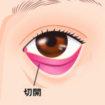 結膜側の切開