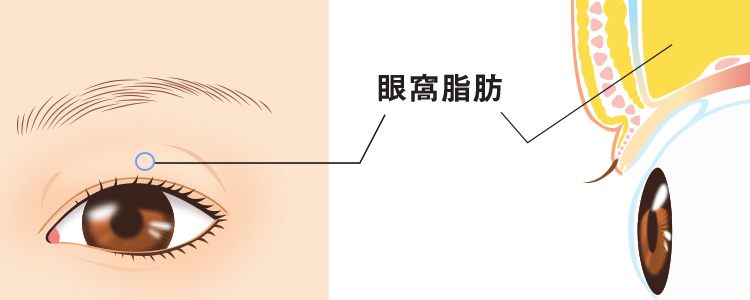 上まぶたの脂肪取り