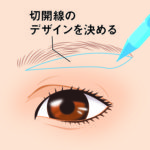 眉下皮膚切除01