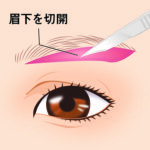 眉下皮膚切除02