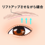 眉下皮膚切除04