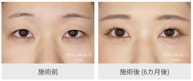 二重全切開ビフォアアフター