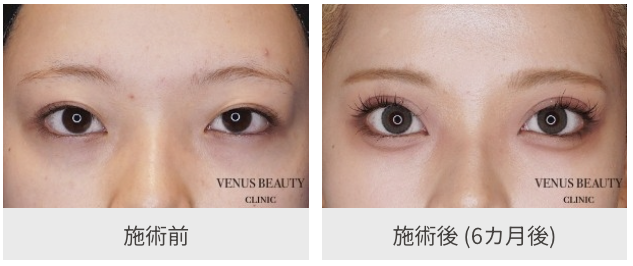 二重全切開ビフォアアフター