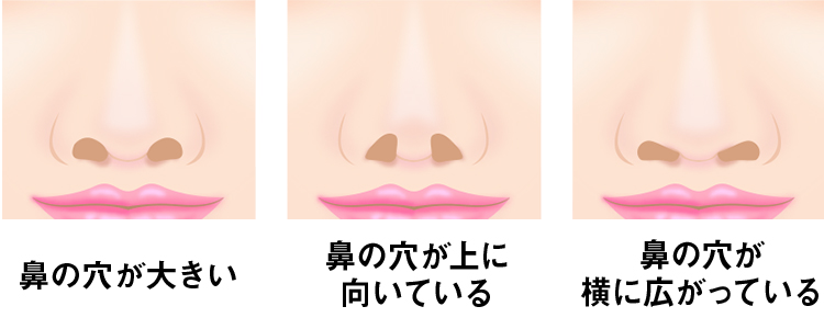 鼻孔縁軟骨移植