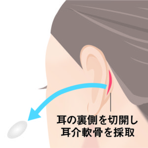 鼻孔縁軟骨移植