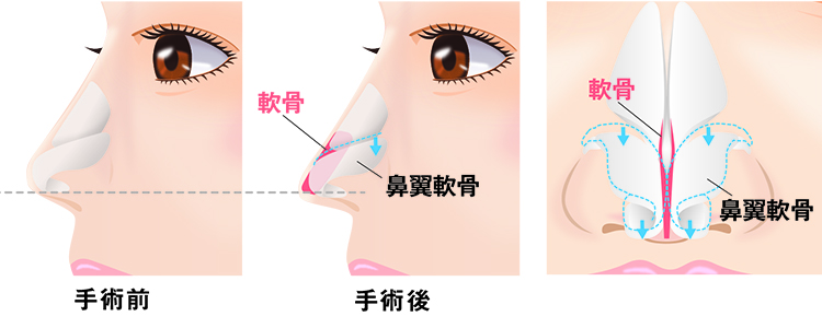 鼻中隔延長（豚鼻改善）とは