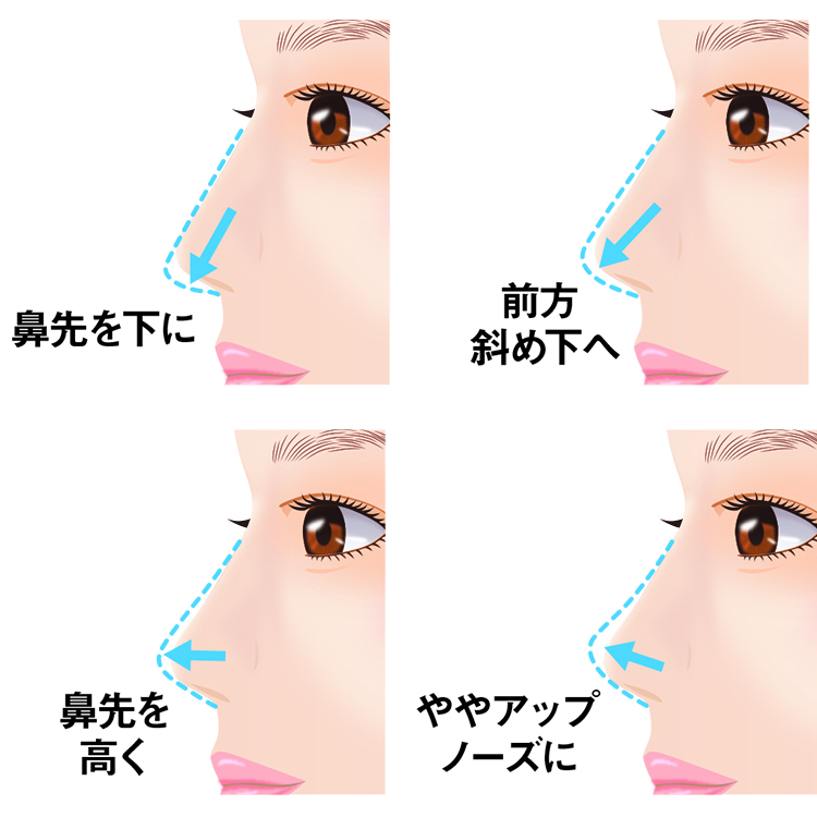 鼻中隔延長の効果について