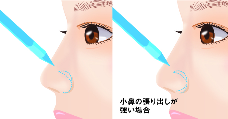 鼻翼挙上デザイン