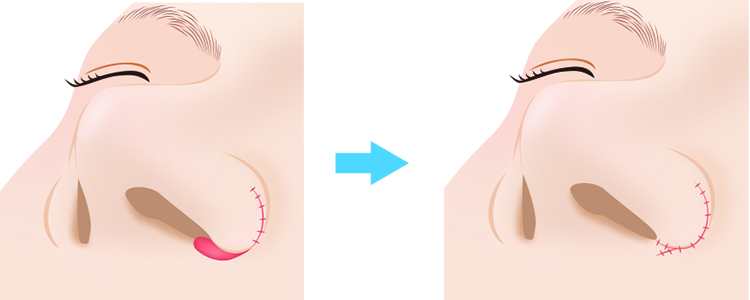 鼻翼挙上 縫合