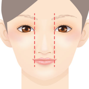 鼻翼縮小（小鼻縮小） 埋没法デザイン