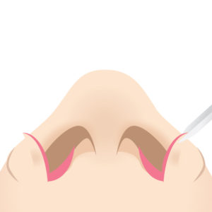 鼻翼縮小（小鼻縮小）　内側切開法手術