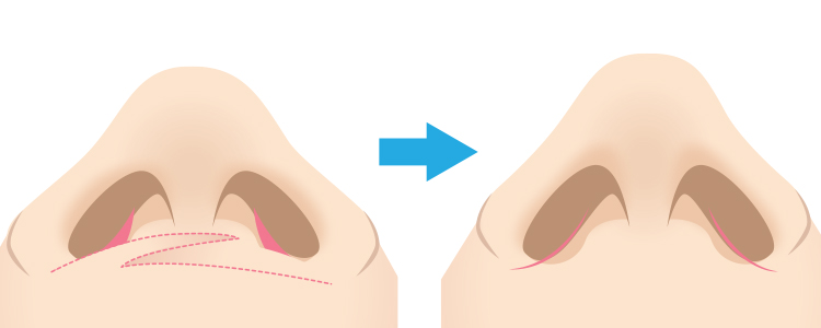 鼻翼縮小（小鼻縮小）　内側切開法縫合