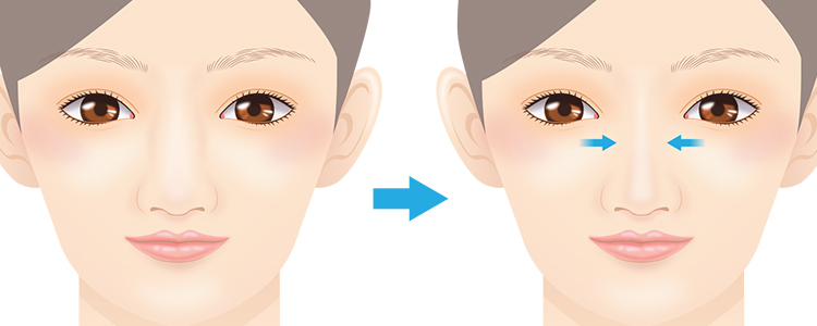 鼻骨切幅寄せとは2