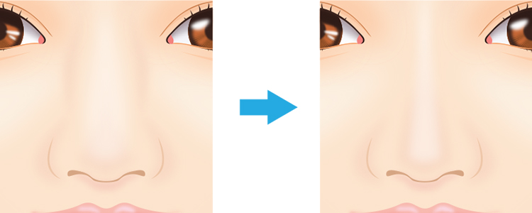 鼻骨切幅寄せの効果について