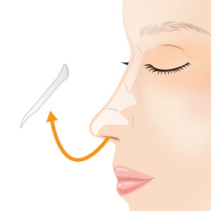 プロテーゼ抜法