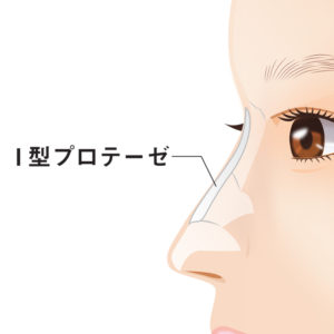 プロテーゼ抜法