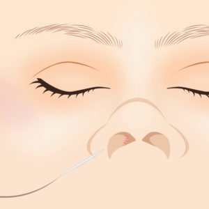 プロテーゼ抜法