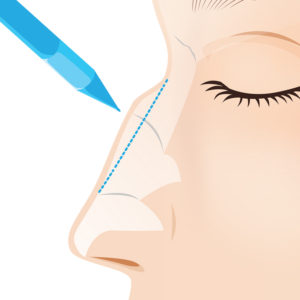 わし鼻段鼻修正