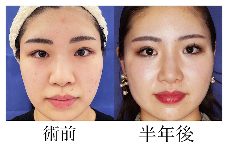 骨切り幅寄せ_d