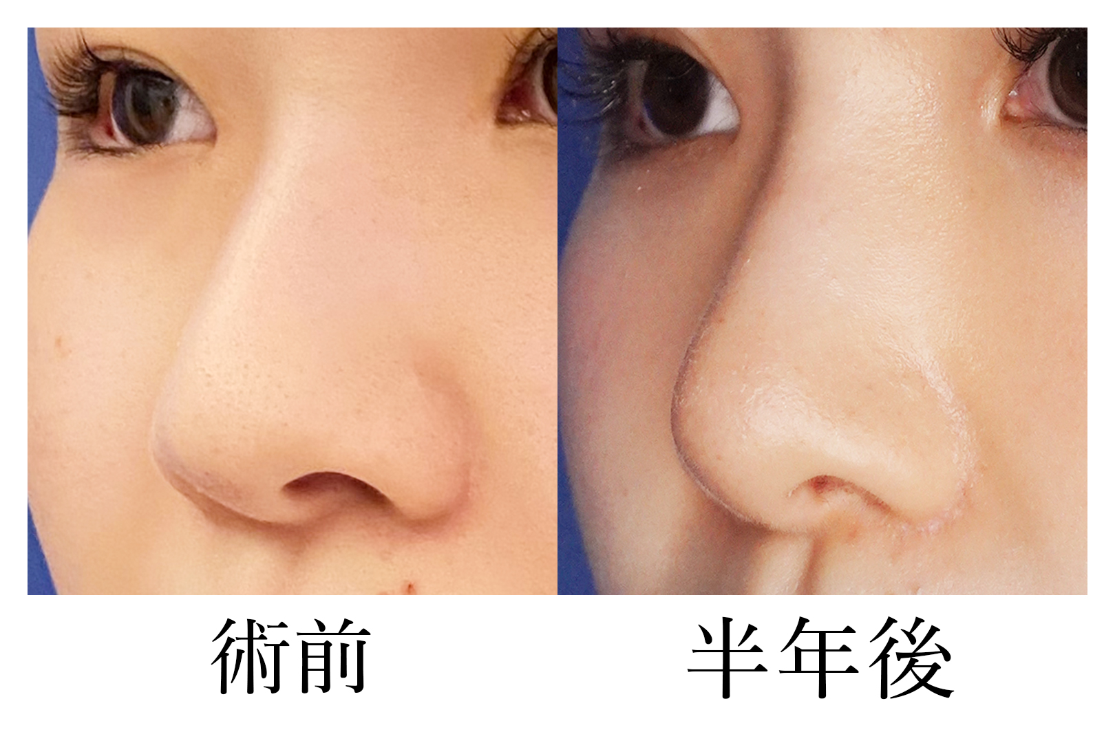 鼻中隔延長（豚鼻改善） 症例写真