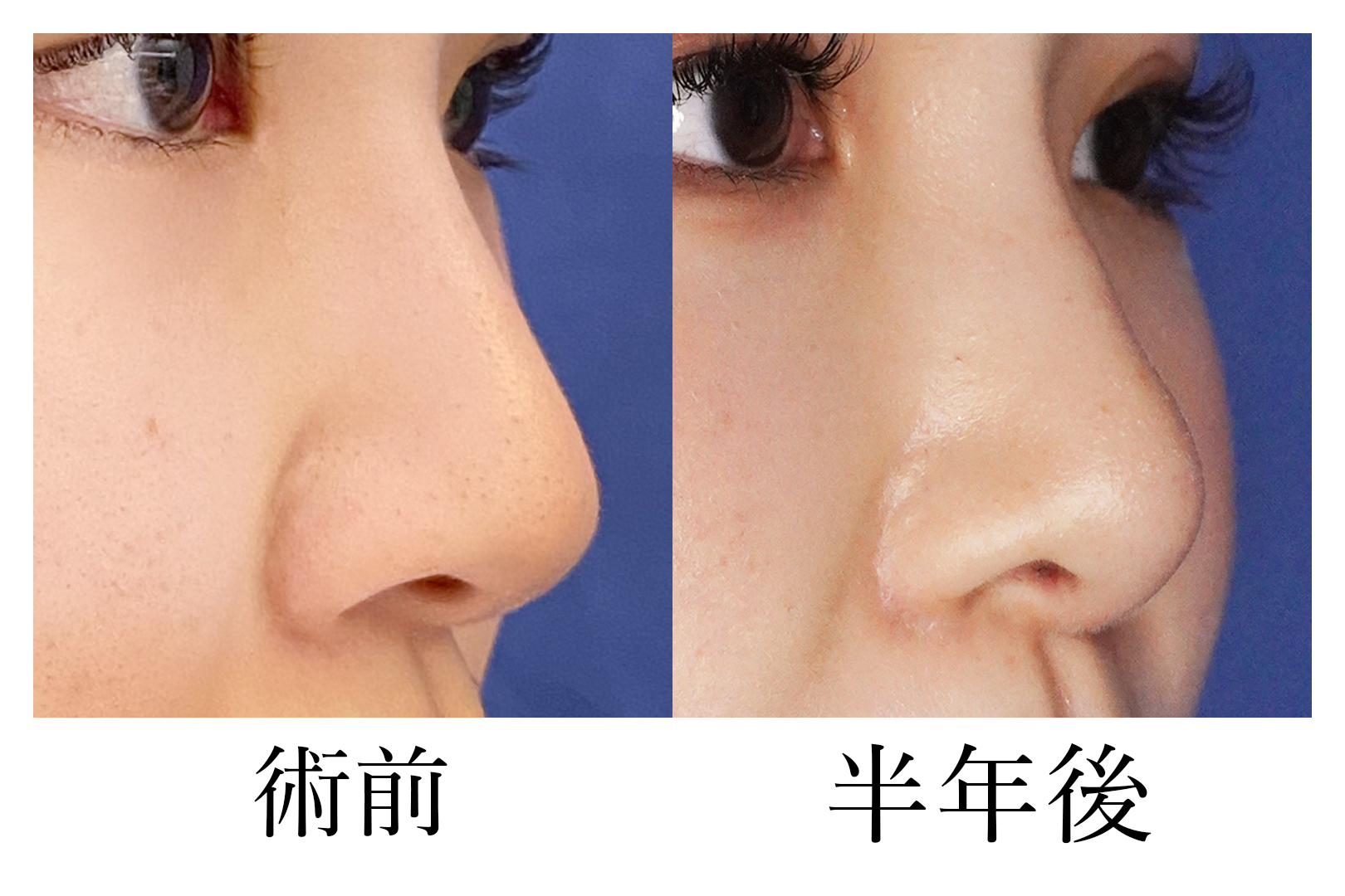 鼻中隔延長（豚鼻改善） 症例写真2