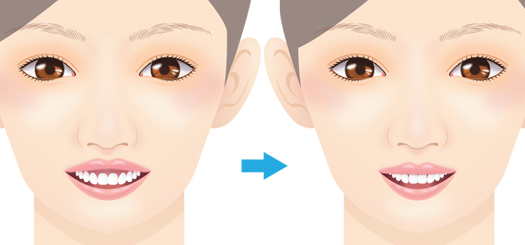 ガミースマイル